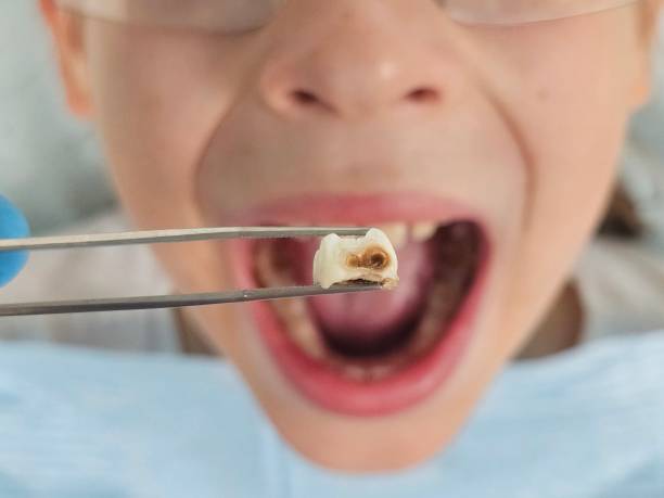 Best Emergency Tooth Extraction in Italy, TX